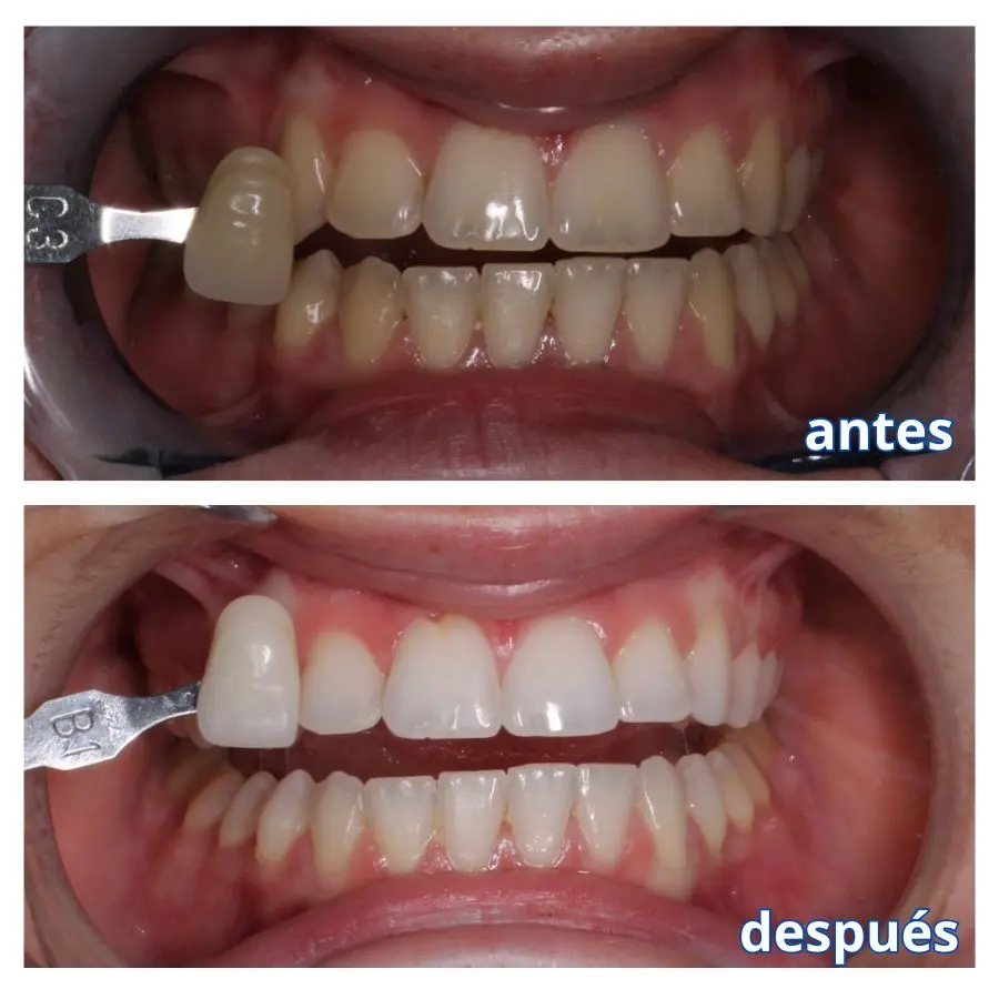 Blanqueamiento dental con Prevdent en Clínica de Mora