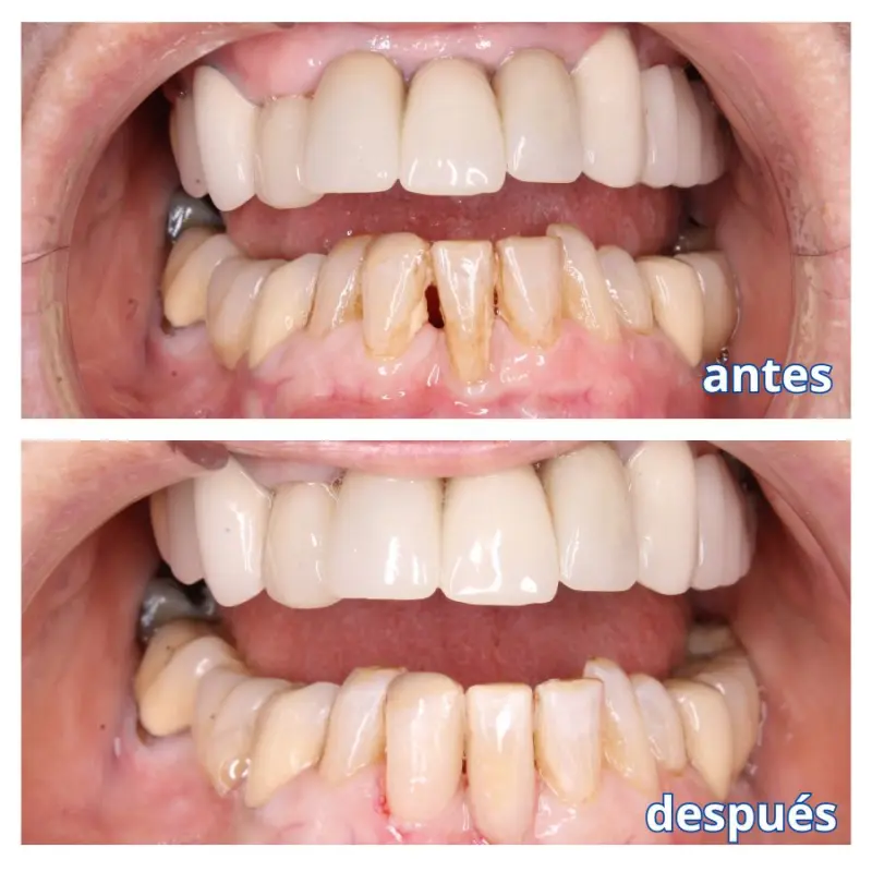 Caso Clínico: Carillas de composite tras tratamiento periodontal
